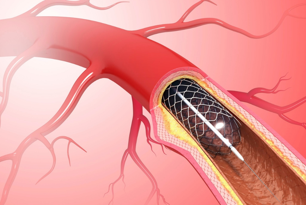 Understanding Carotid Artery Stenting